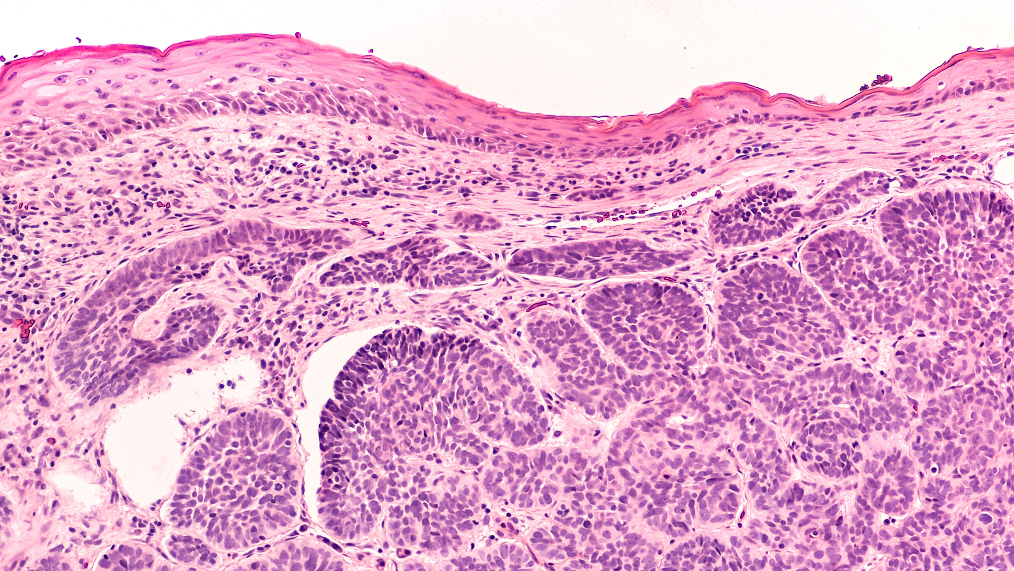Skin biopsy pathology of basal cell carcinoma, the most most common type of sun induced skin cancer, invading the dermis and involving inked deep margin.