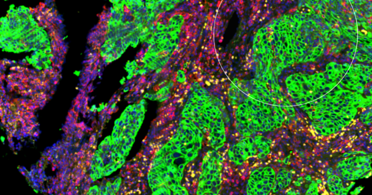 Spatially Resolved Deconvolution of the Fibrotic Niche in Lung Fibrosis