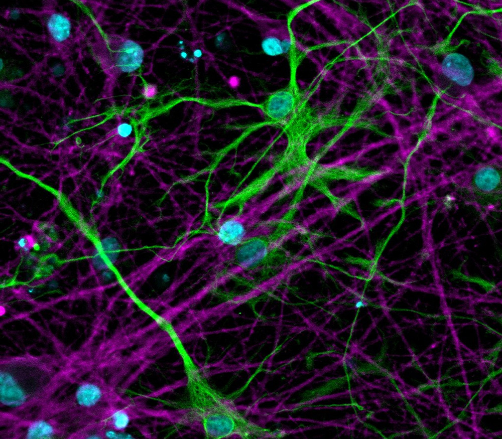 LSM880 confocal image of fixed IPSC-derived Huntington’s disease neurones (magenta) in coculture with rat astrocytes (green). Nuclei are shown in blue.