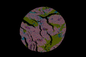 Data from the 10x Genomics Xenium platform molecularly profiles up to 5,000 transcripts at the single-cell level in FFPE tissue.