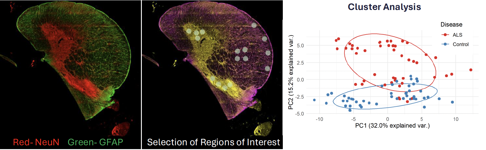 GeoMx DSP platform used to examine spatial differences in the protein profile of human spinal cord tissue in Amyotrophic Lateral Sclerosis.