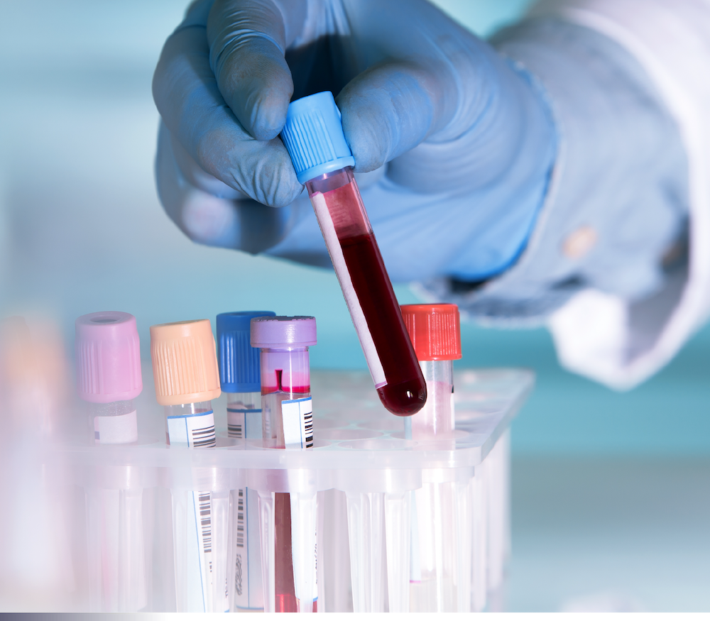 A photo of liquid biopsy samples for biomarker identification